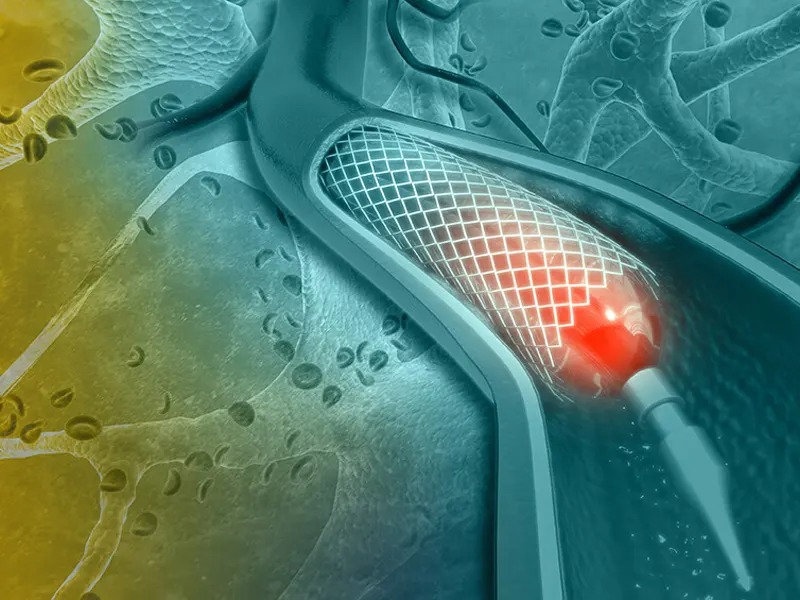 بالون زدن قلب