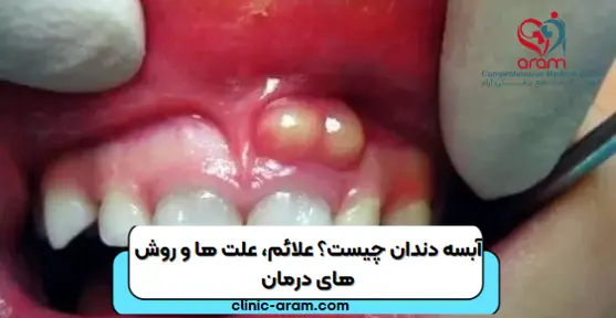 آبسه دندان