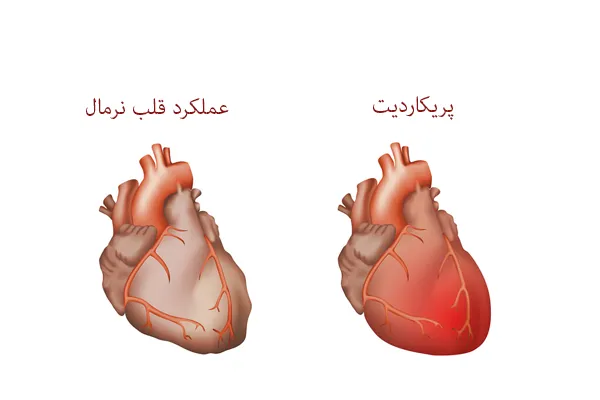 درمان التهاب درون قلب