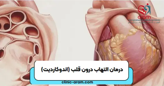 التهاب درون قلب