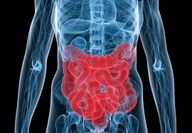 انسداد روده