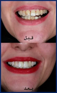 بلیچینگ دندان