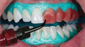 بلیچینگ دندان