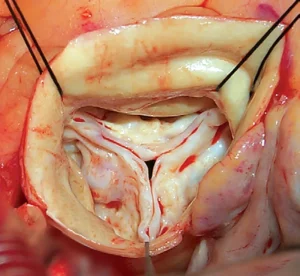 تنگی دریچه ائورت