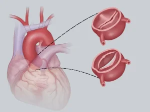 تنگی دریچه ائورت