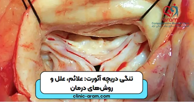 تنگی دریچه ائورت