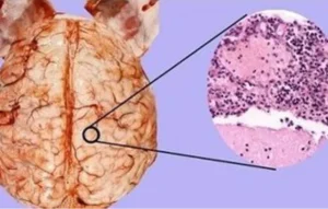 درمان مننژیت