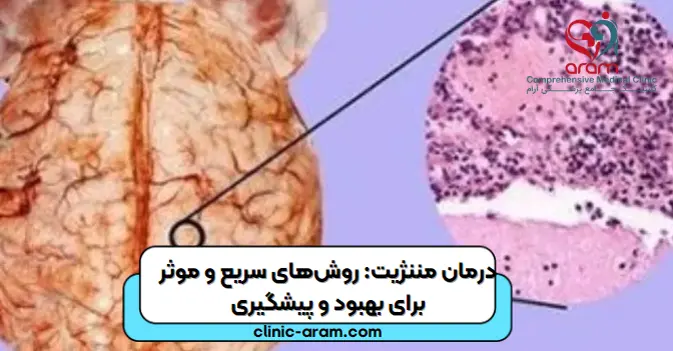 درمان مننژیت