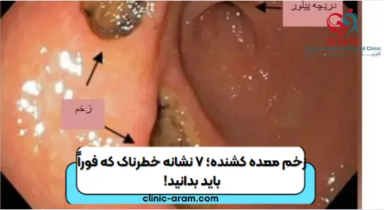 زخم معده کشنده