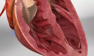 سوراخ قلب نوزاد