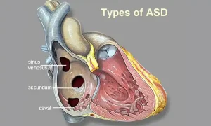 سوراخ قلب نوزاد