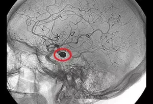 لخته خون در مغز