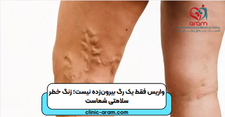 واریس چیست